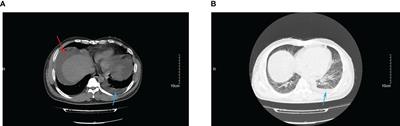 Bloodstream infection, peritonitis, and pneumonia caused by Pasteurella multocida in a patient with liver cirrhosis despite no animal contact: case report and literature review